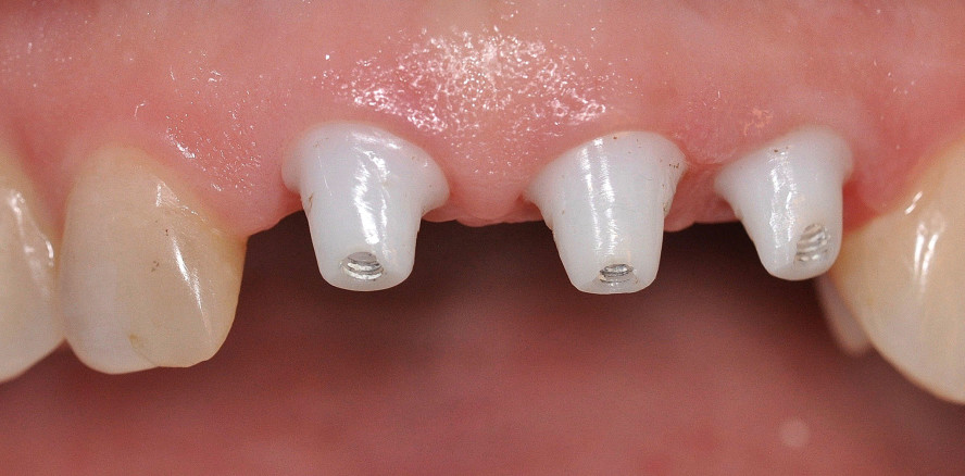 Optimale Ästhetik mit Keramikimplantaten