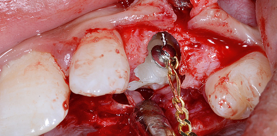 Chirurgische Freilegung palatinal verlagerter Zähne