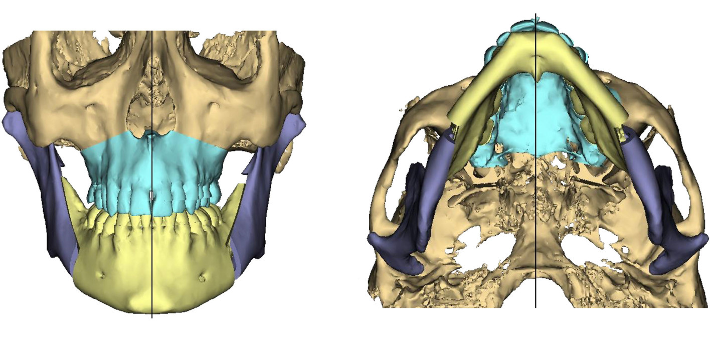 Digitale Planung in der chirurgischen Therapie des obstruktiven Schlafapnoe-Syndroms