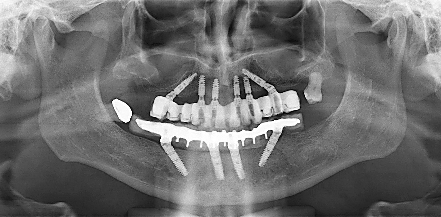 Extensionen bei Implantatsuprastrukturen