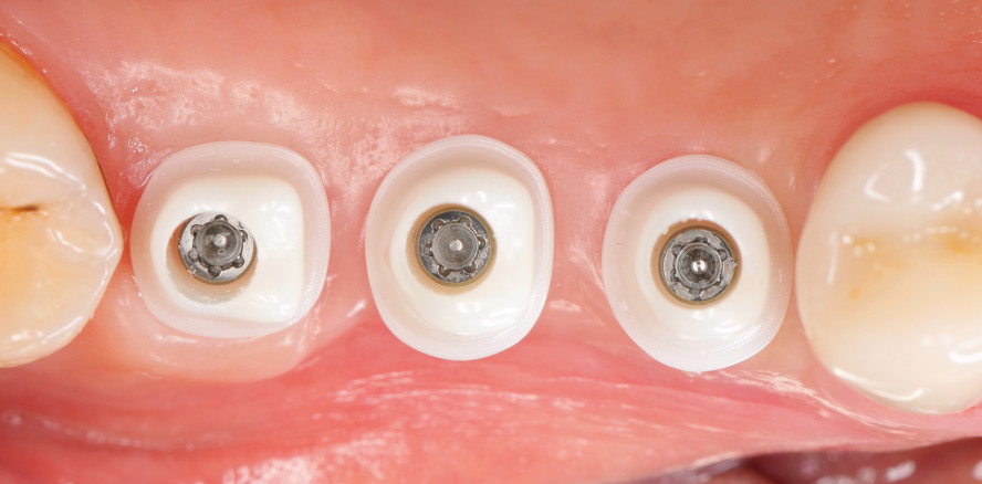 Individuelle CAD/CAM-Abutments auf Keramikimplantaten