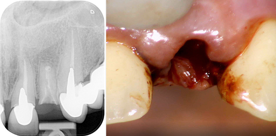Sofortimplantation nach Frontzahntrauma