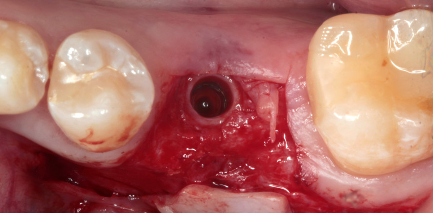 Vorgehensweise mit dem Stable Tissue Concept