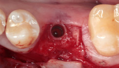 Vorgehensweise mit dem Stable Tissue Concept