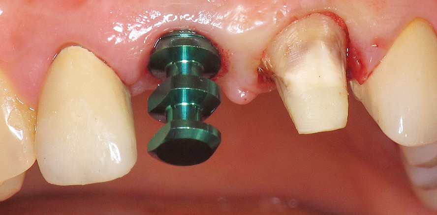 Sofortimplantat mit Sofortversorgung bei hoher Lachlinie