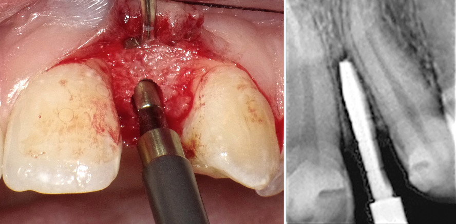 Interproximale Wurzelspreizung für eine Implantatinsertion