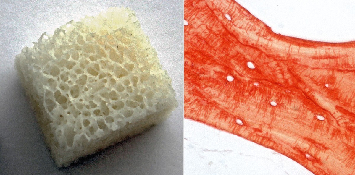 Update: Allogene Knochenersatzmaterialien