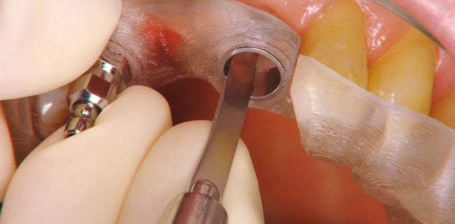 Chirurgischer Mehrwert von Guided Surgery