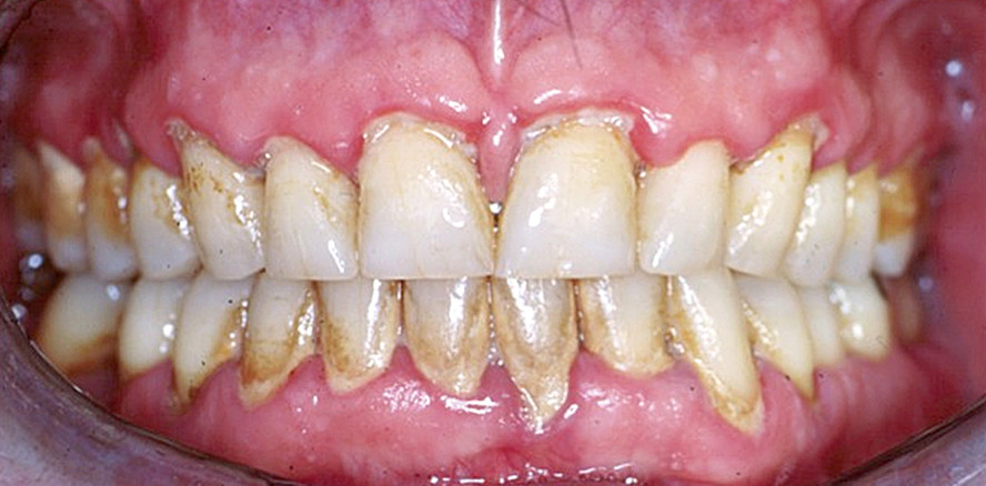 Antiresorptive Medikamente