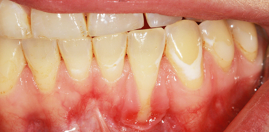 Parodontitis: Vor der Therapie steht die Diagnose