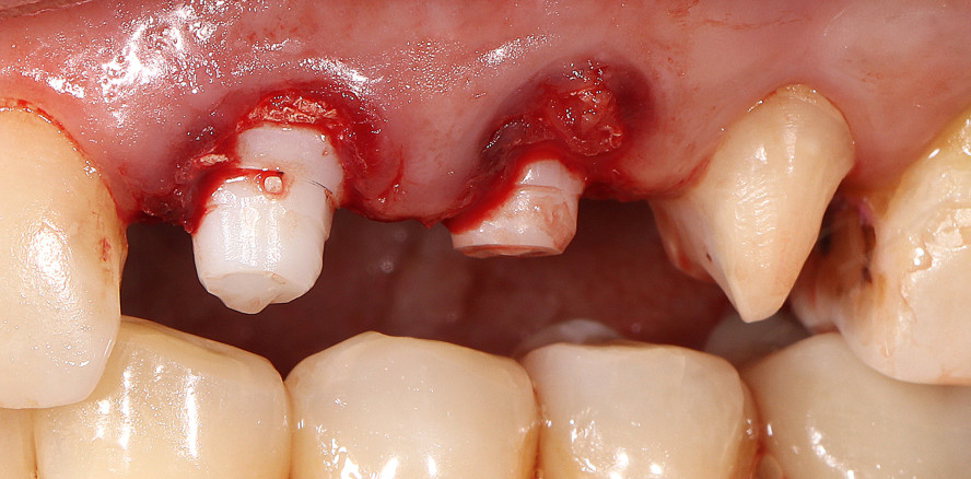 Metallfreie Sofortimplantation bei stark reduziertem Knochenangebot