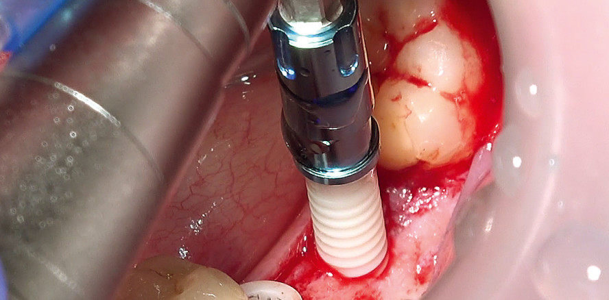 Zweiteilige Keramikimplantate bei kompromittiertem Knochen