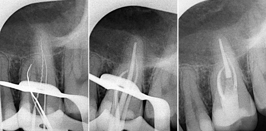 Therapie bei engen, stark gekrümmten oder langen Kanälen