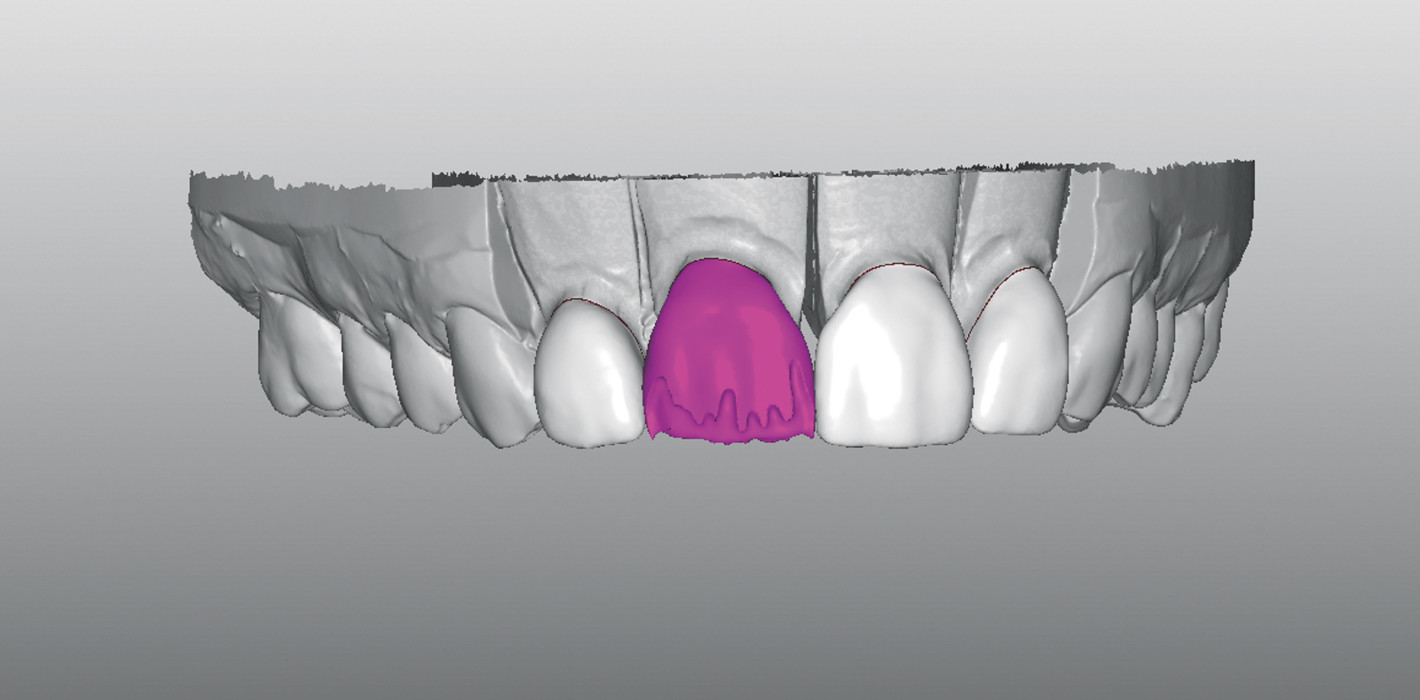 Diastema mediale: Digital konstruiert, manuell gefinisht