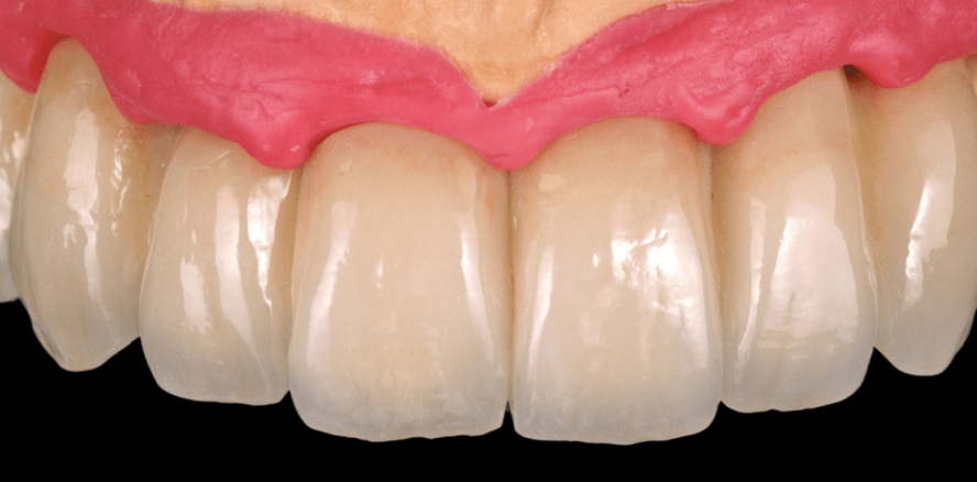 Damals wie heute: Sofortversorgung bei totalem Zahnverlust