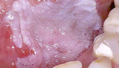 Differenzialdiagnosen weißer Schleimhautveränderungen