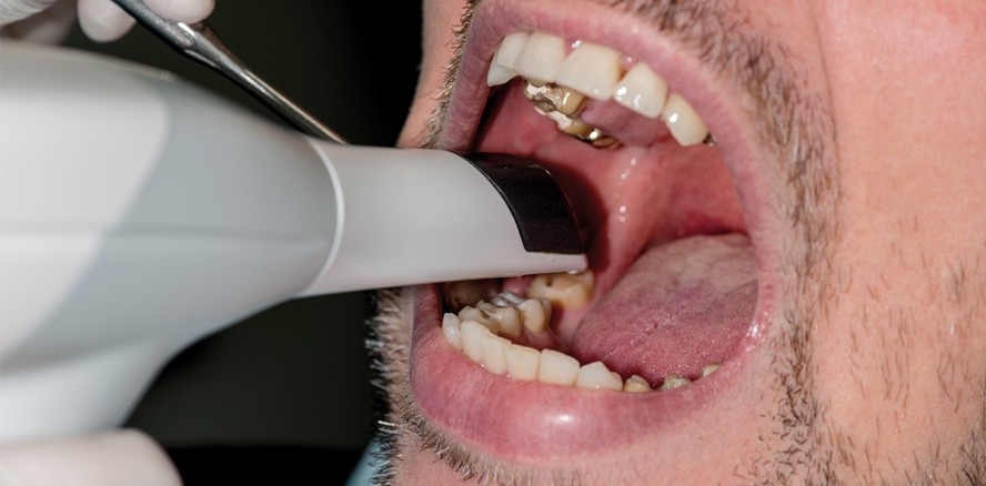 Intraoralscan ­komplettiert digitalen Laborworkflow