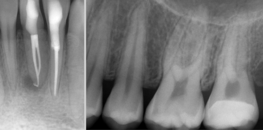 Die digitale Volumentomografie in der Endodontie