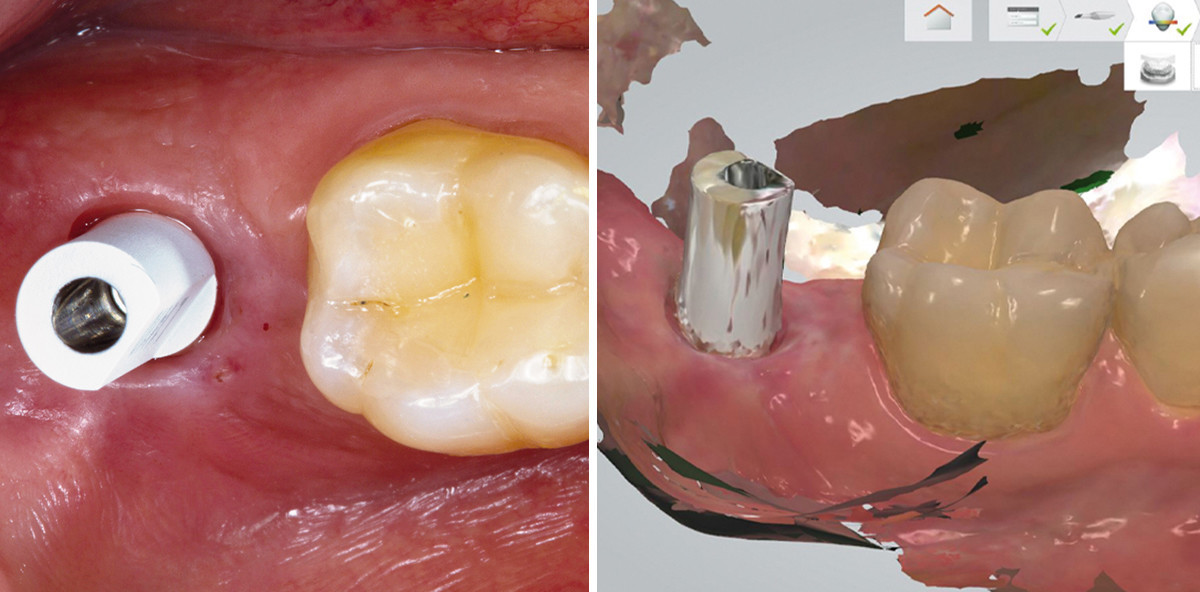 Implantatgestützte Einzelkronen im digitalen Workflow