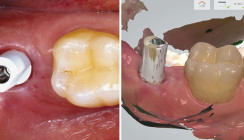 Implantatgestützte Einzelkronen im digitalen Workflow