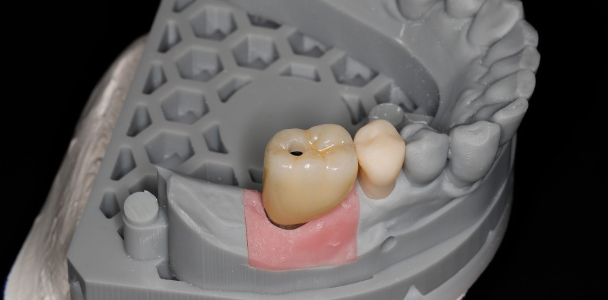 Der digitale Workflow in der zahnärztlichen Prothetik – ein Überblick