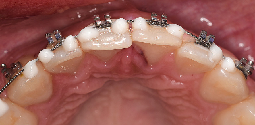 Therapie einer lateralen Dislokationsverletzung
