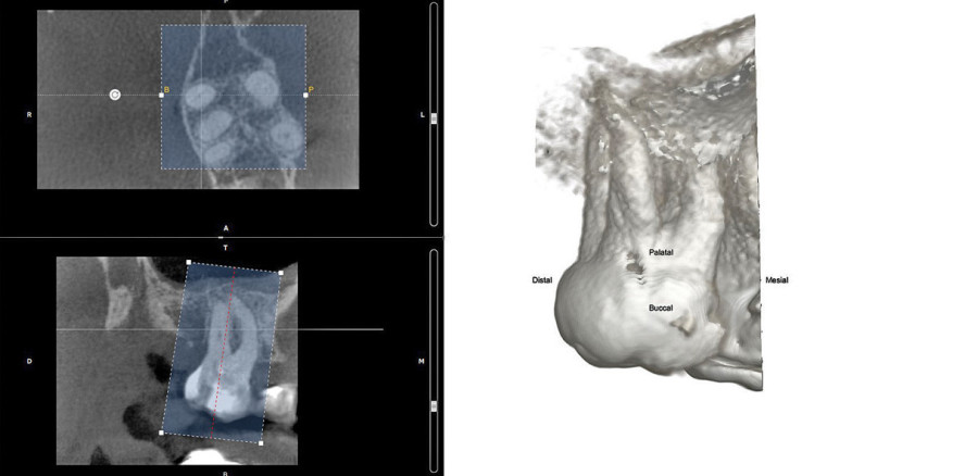 Die dreidimensionale endodontische Behandlungsplanung