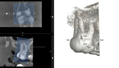 Die dreidimensionale endodontische Behandlungsplanung
