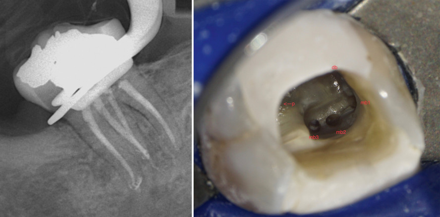 WKB mit NiTi-Feilen in Verbindung mit biokeramischen Sealern