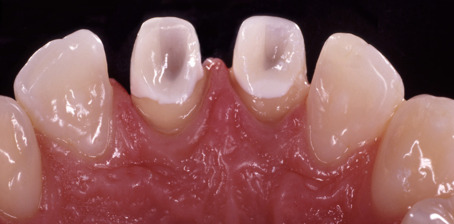 Langzeitstabile Restauration stark verfärbter Frontzähne