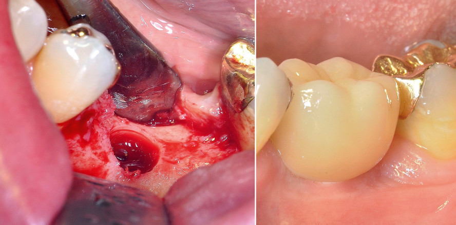 Versorgung einer Einzelzahnlücke im Molarenbereich