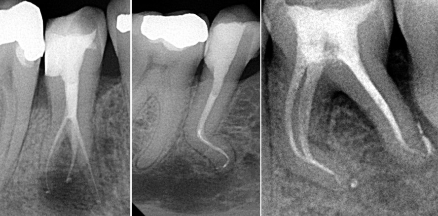 Wurzelkanalanatomie: Maximale Kontrolle in der Kurve