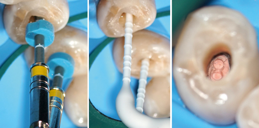 Revision eines Zahns mit doppelter Kanalkrümmung