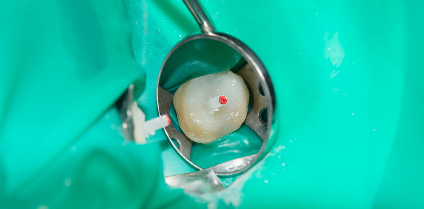 Erfolgsrate postendodontischer Stiftversorgungen