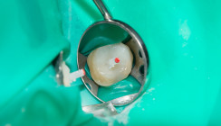Erfolgsrate postendodontischer Stiftversorgungen