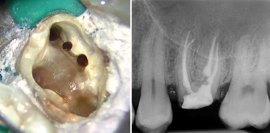 Endodontischer Wiederaufbau bei außergewöhnlicher Anatomie
