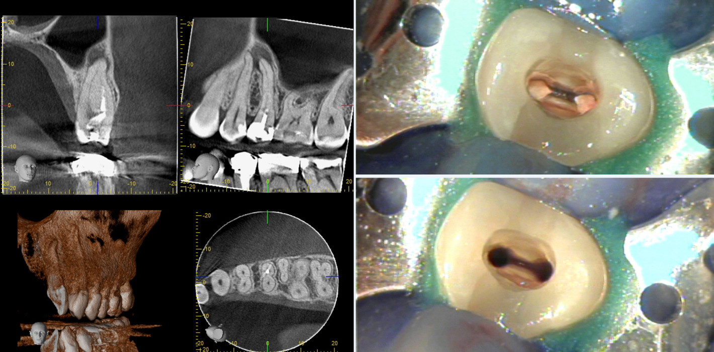 Ein einfacher Fall? Endodontische Diagnostik mithilfe des DVT