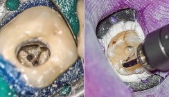 Einsatz des AdvErL EVO-Lasers in der Endodontie