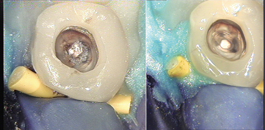 Orthograde Revision eines resezierten Unterkieferprämolaren