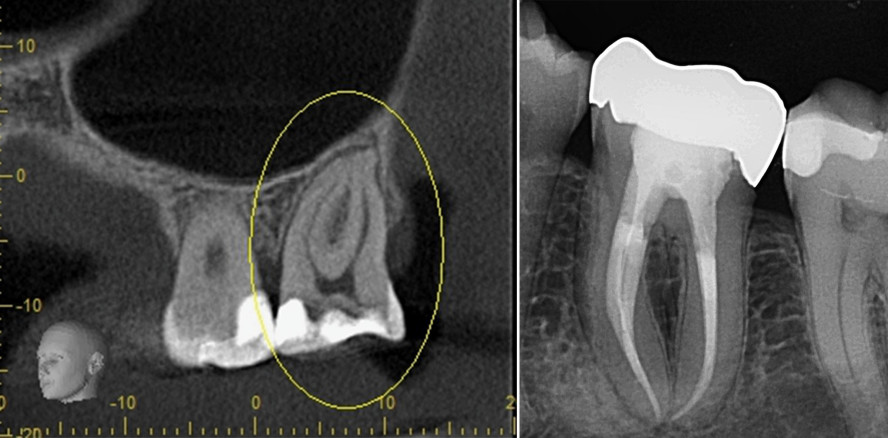 Effizienz und Sicherheit im Fokus: Die endodontische System­frage