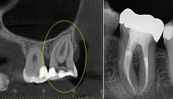 Effizienz und Sicherheit im Fokus: Die endodontische System­frage