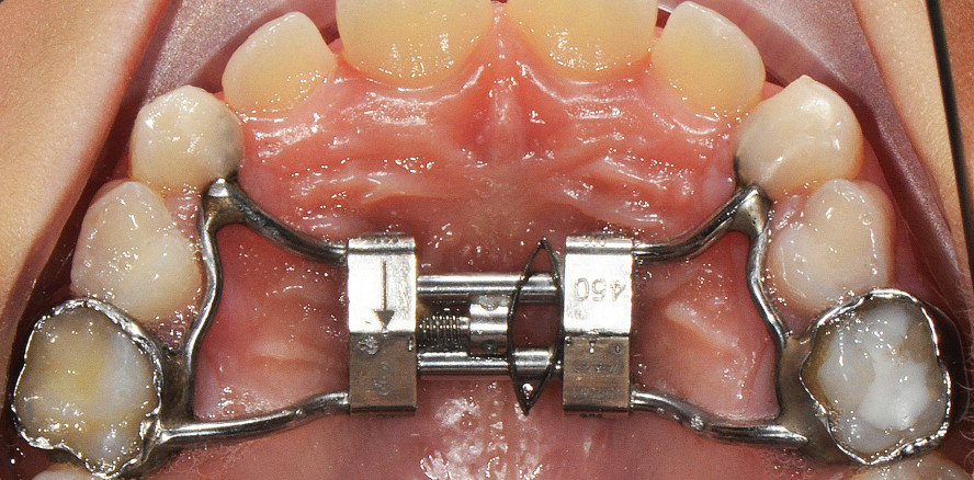 Langsame maxilläre Expansion mithilfe des Leaf Expanders