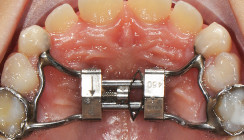 Langsame maxilläre Expansion mithilfe des Leaf Expanders