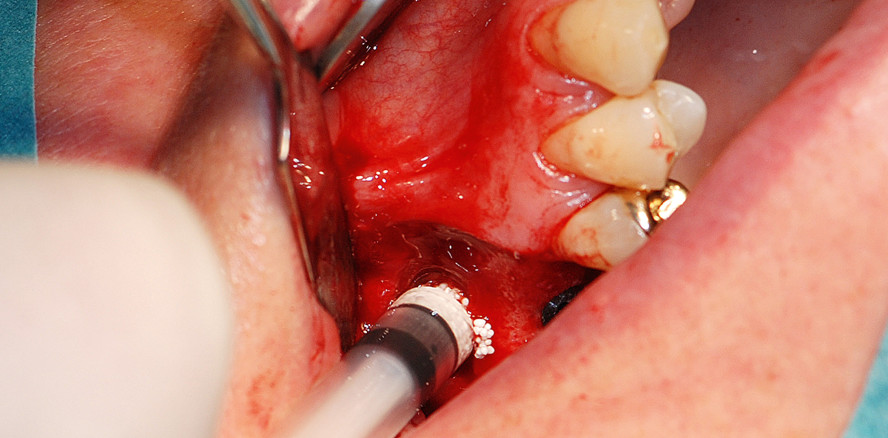 Externe Sinusbodenelevation mit gleichzeitiger Implantation