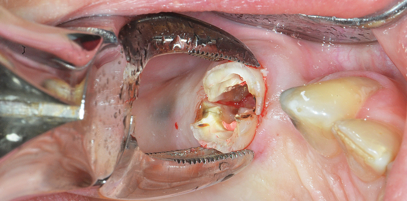 Die minimalinvasive Extraktion und die chirurgische Extrusion