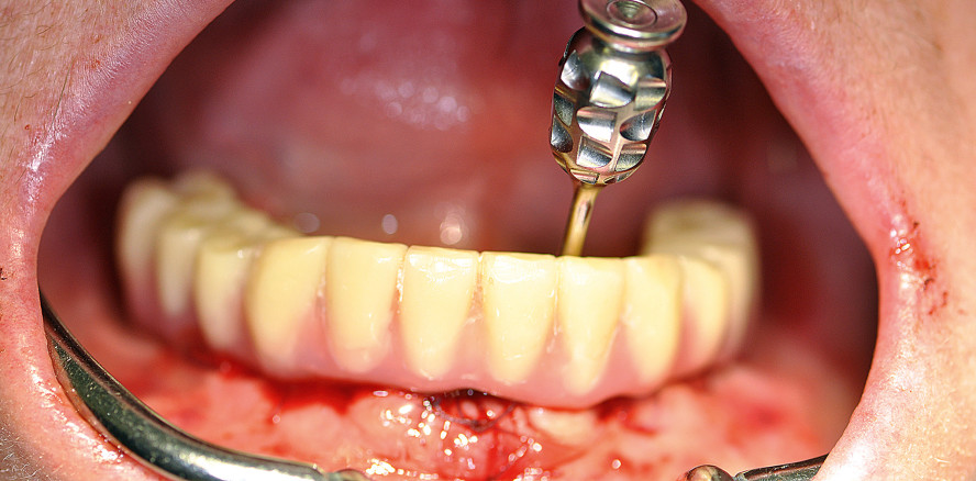 Implantatprothetische Versorgung eines zahnlosen Unterkiefers