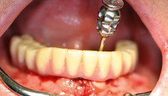 Implantatprothetische Versorgung eines zahnlosen Unterkiefers