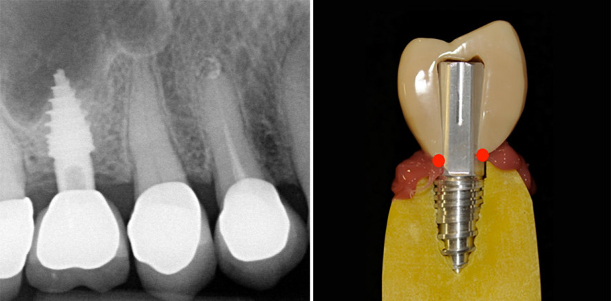 Einteilige Implantatsysteme mit zementierten Suprakonstruktionen