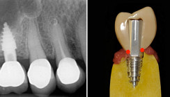 Einteilige Implantatsysteme mit zementierten Suprakonstruktionen