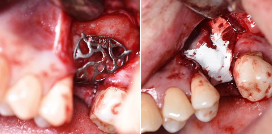 Gedruckte patientenindividuelle Titangitter